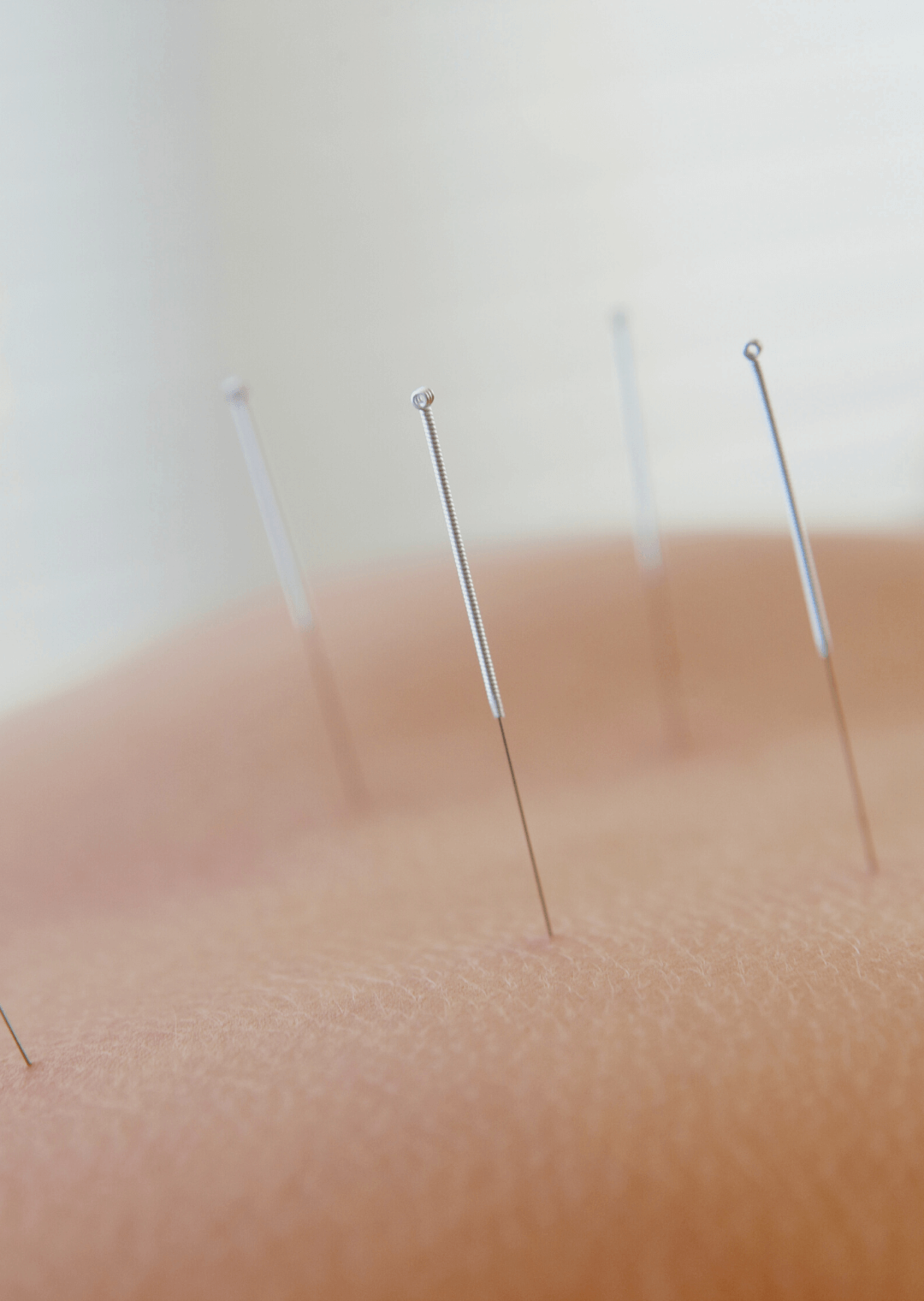 I Curso ElectroNeuroAcupuntura Avanzado      